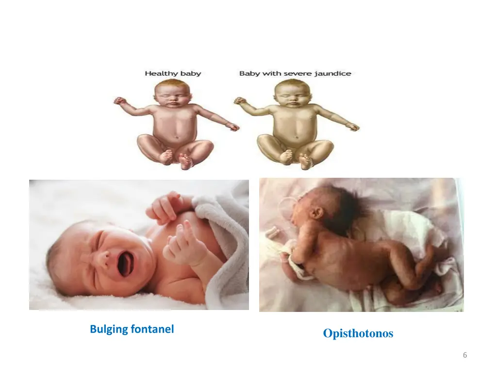 bulging fontanel