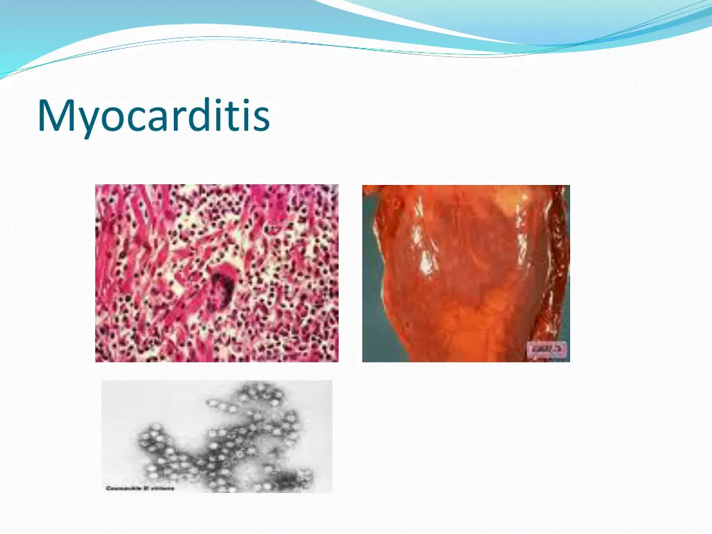 myocarditis