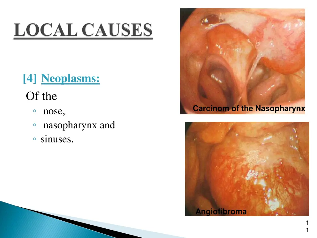 4 neoplasms of the nose nasopharynx and sinuses