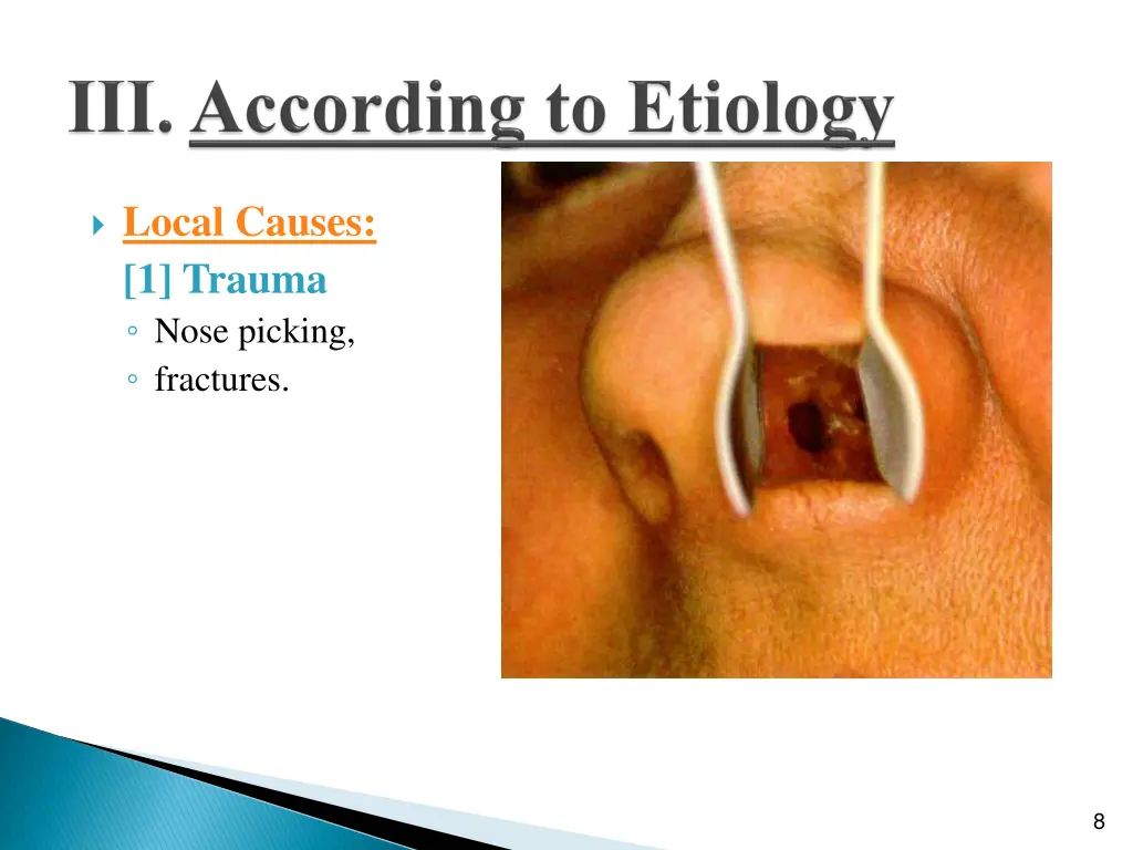 local causes 1 trauma nose picking fractures