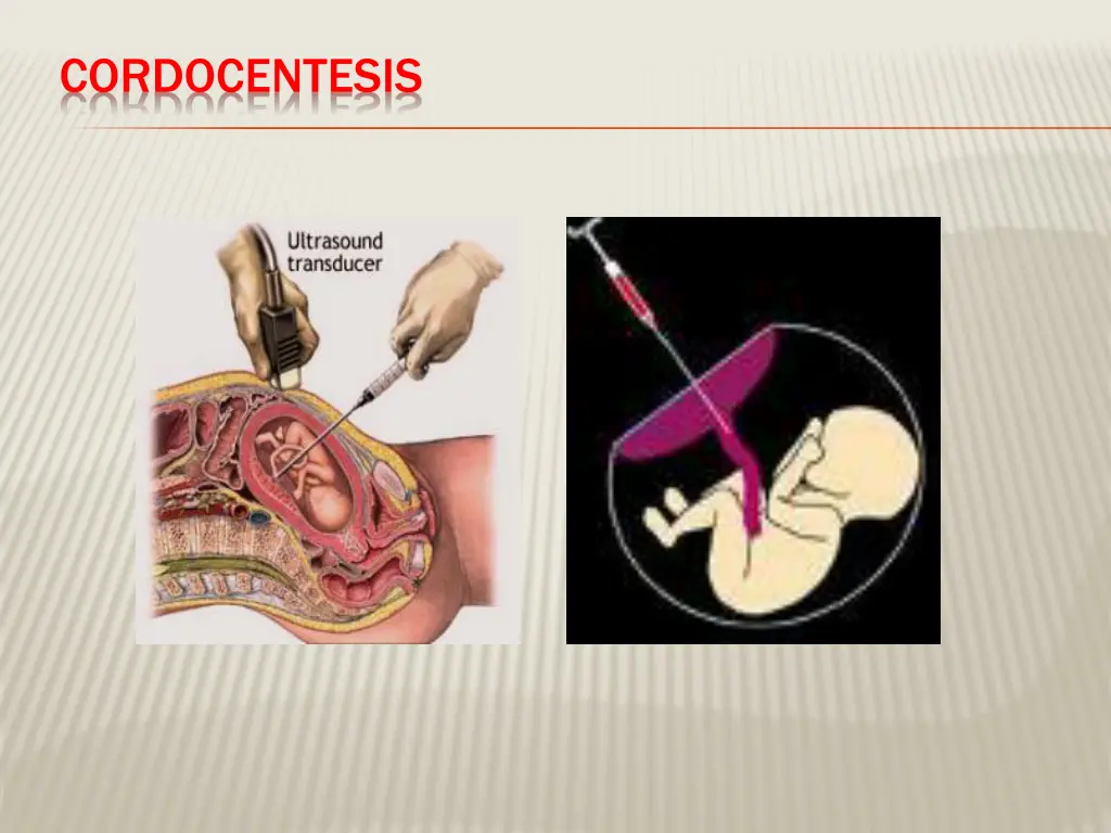 cordocentesis