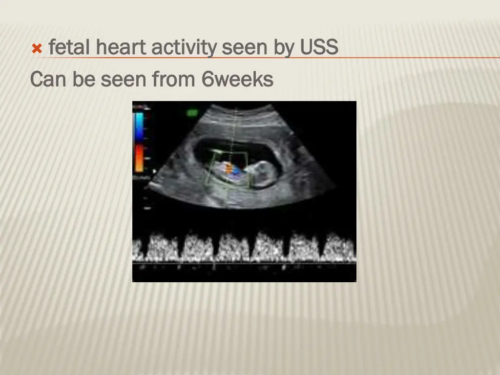 fetal heart activity seen by uss fetal heart