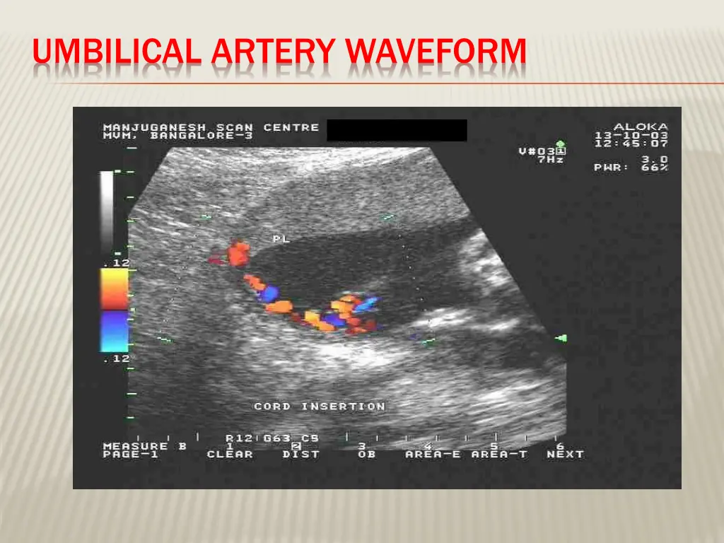 umbilical artery waveform