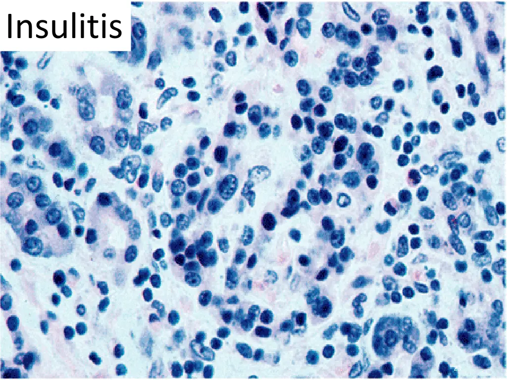insulitis