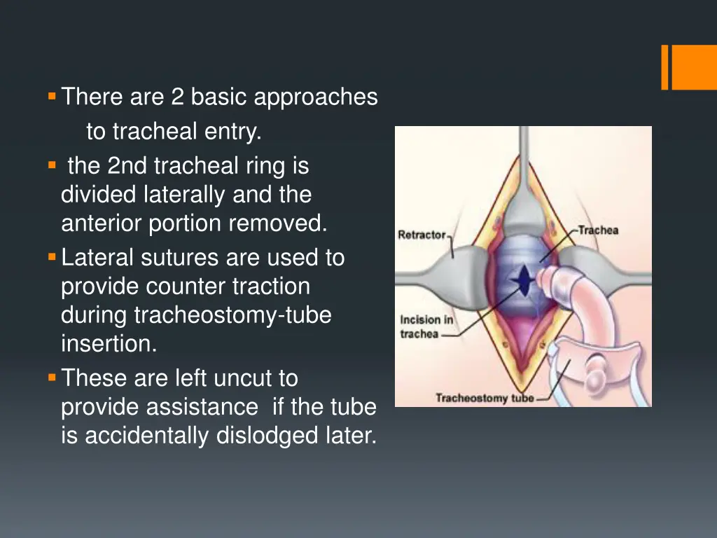 there are 2 basic approaches to tracheal entry