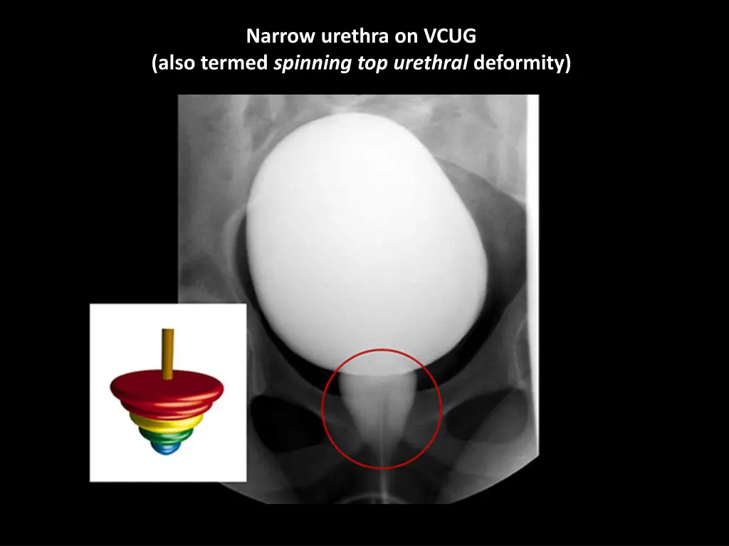 narrow urethra on vcug also termed spinning