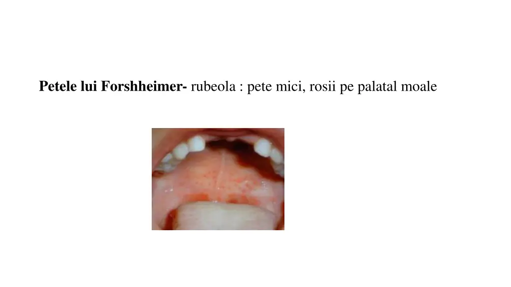 petele lui forshheimer rubeola pete mici rosii