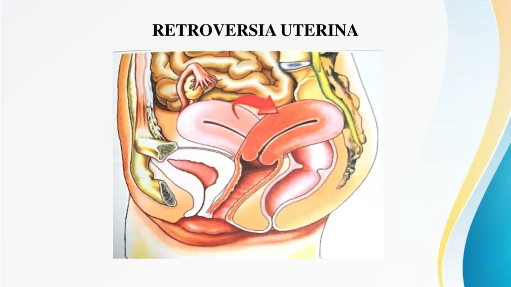 retroversia uterina