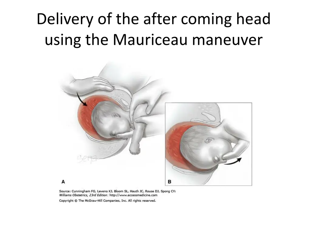 delivery of the after coming head using