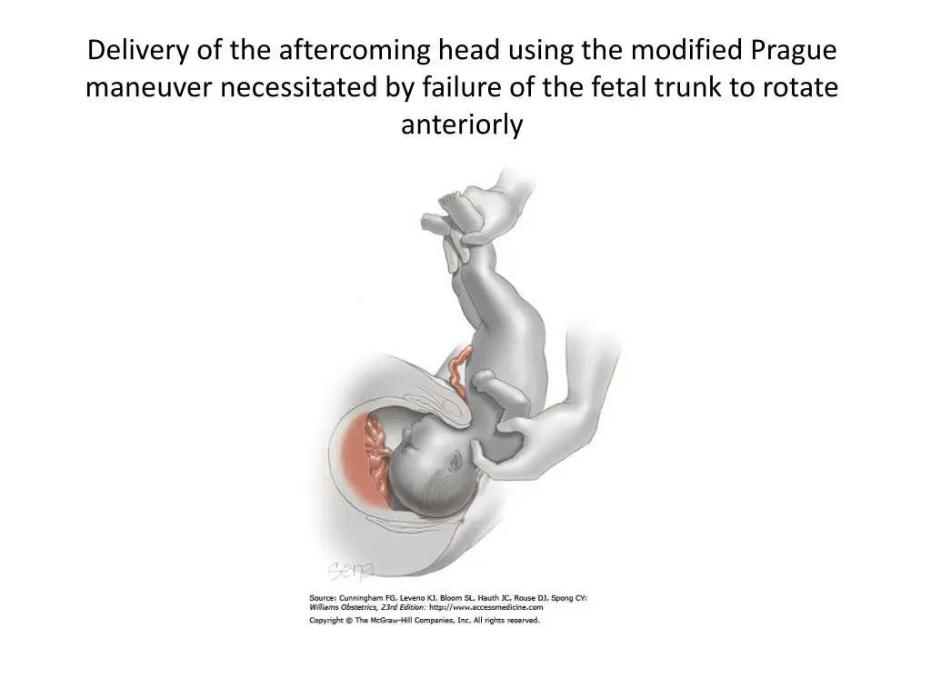 delivery of the aftercoming head using