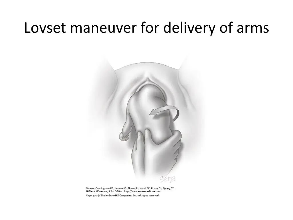 lovset maneuver for delivery of arms