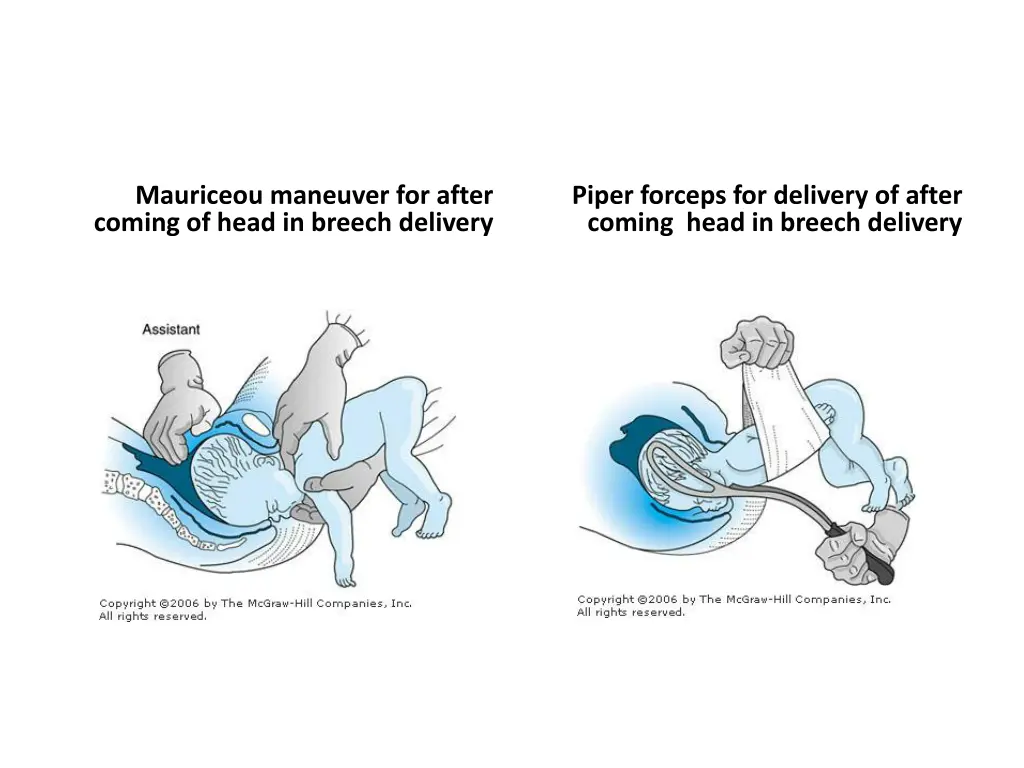 mauriceou maneuver for after coming of head