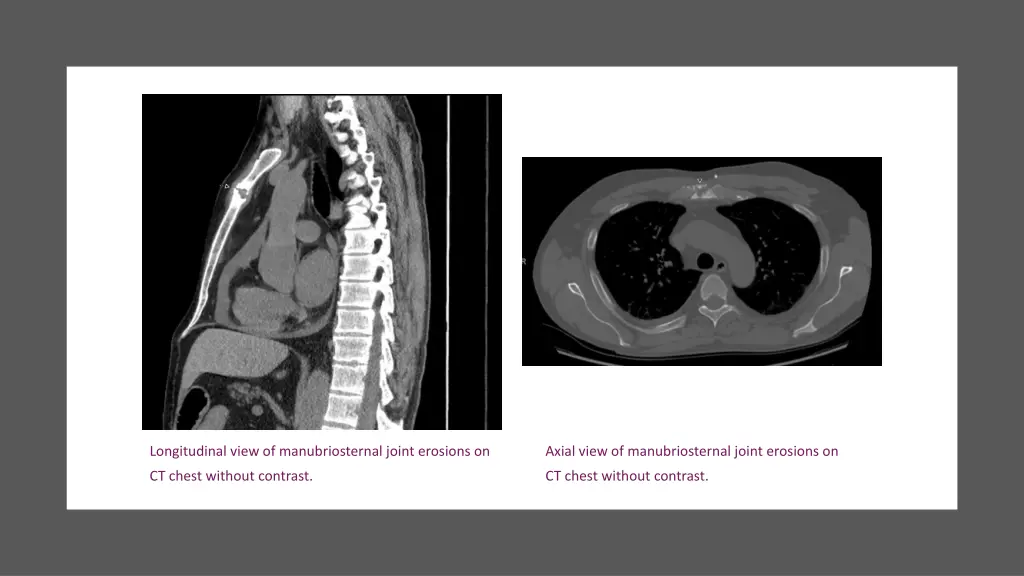 longitudinal view of manubriosternal joint 1