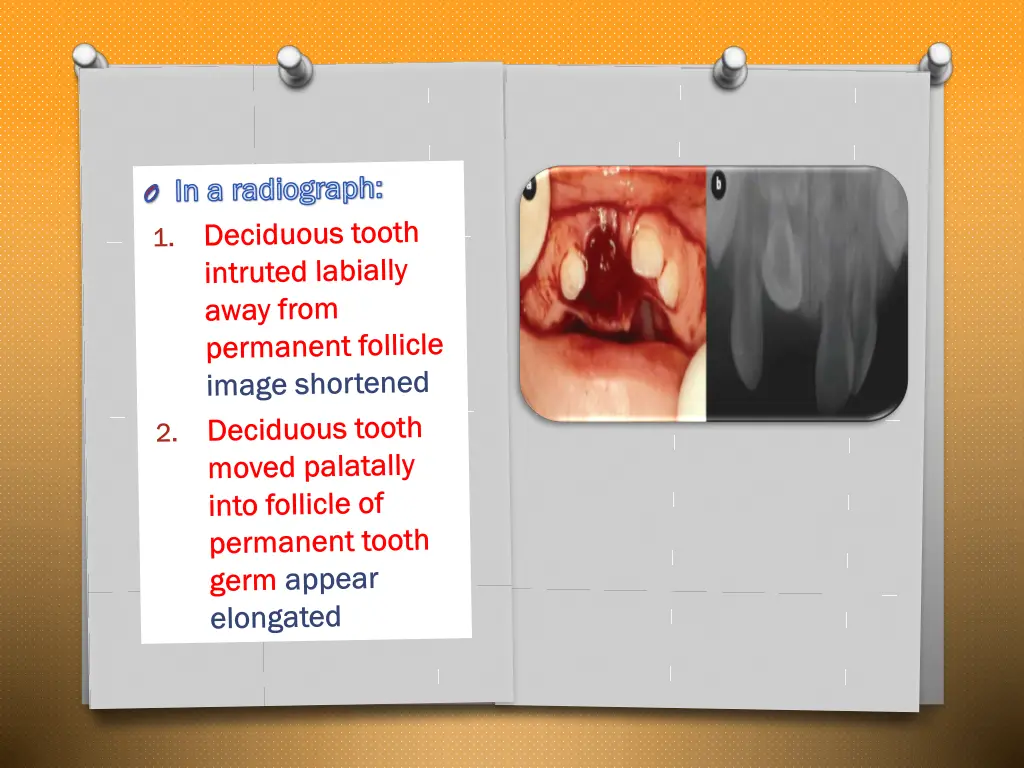 in a radiograph in a radiograph