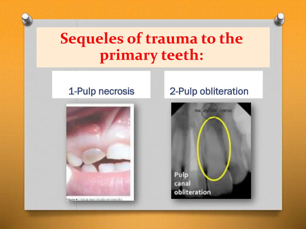 sequelesof trauma to the primary teeth 1