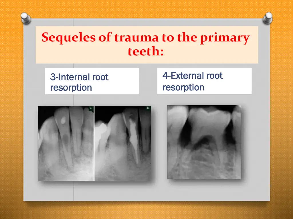 sequelesof trauma to the primary teeth 3