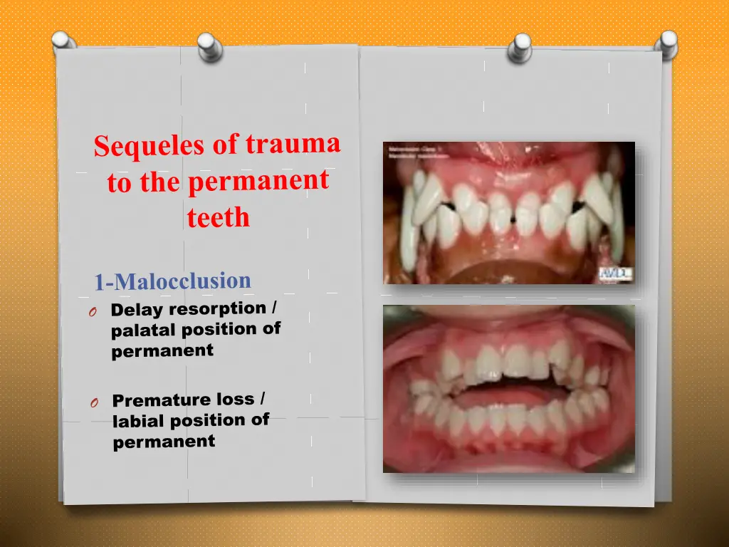 slide22