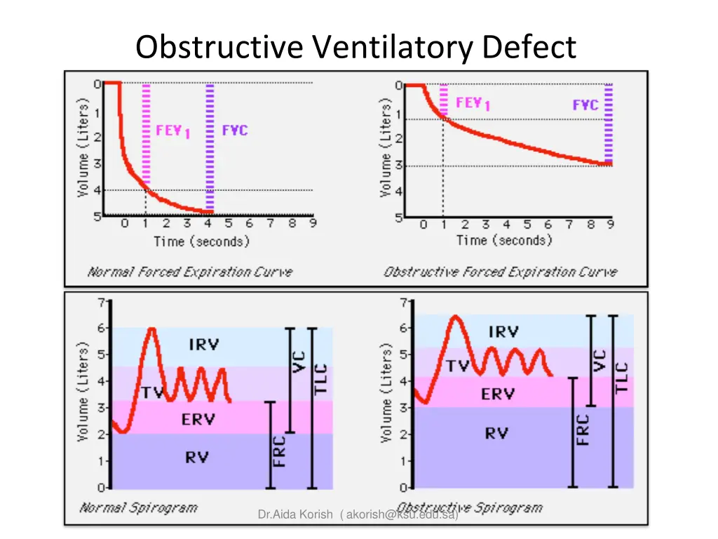 obstructive ventilatory defect