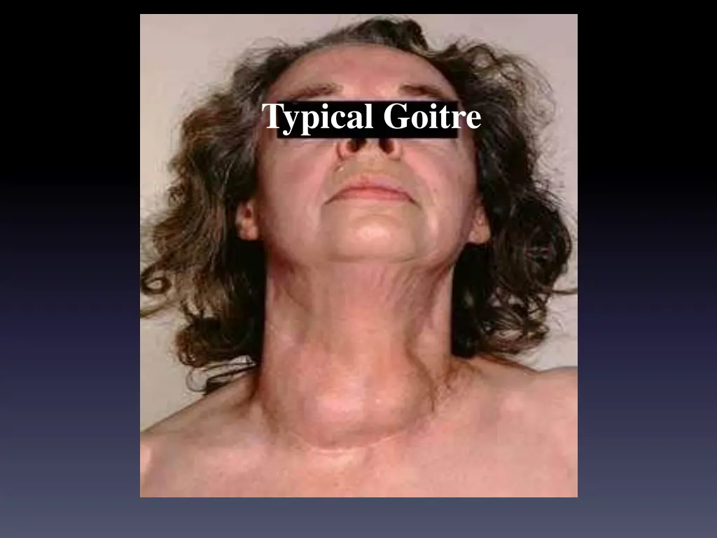 typical goitre