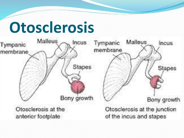 otosclerosis