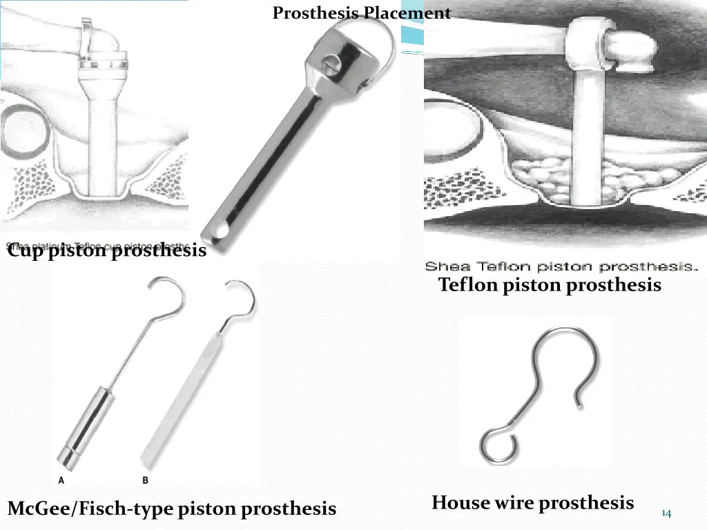 prosthesis placement