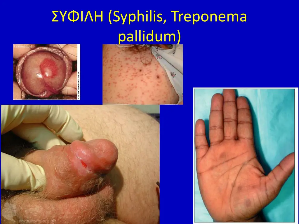 syphilis treponema pallidum