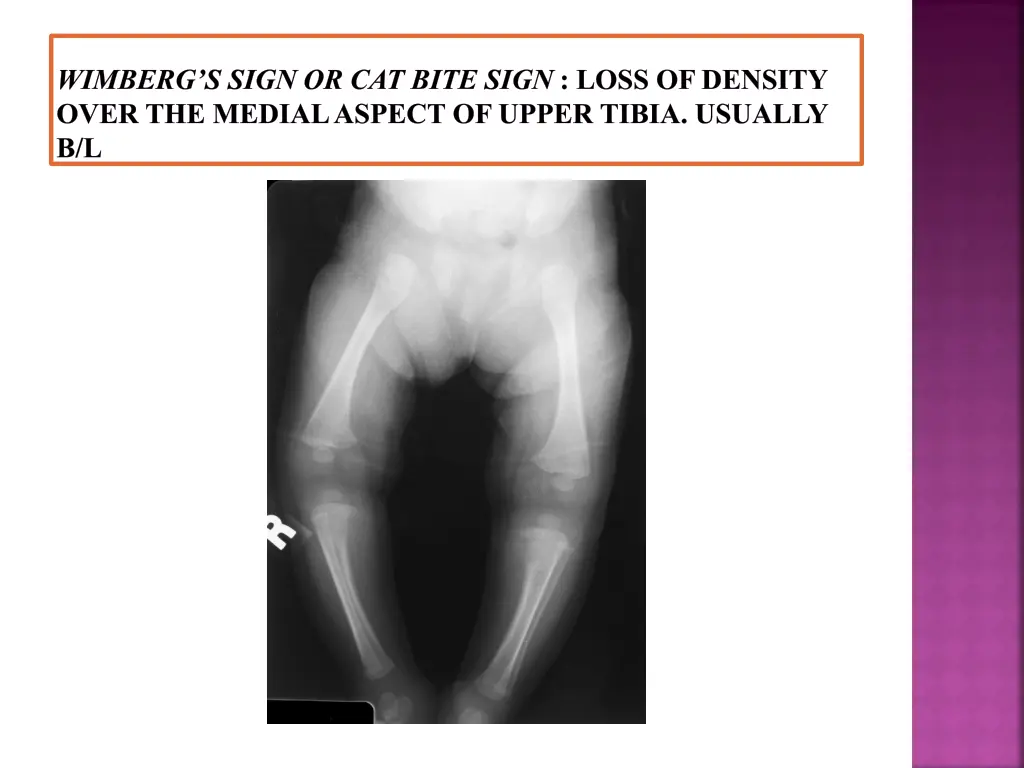 wimberg s sign or cat bite sign loss of density
