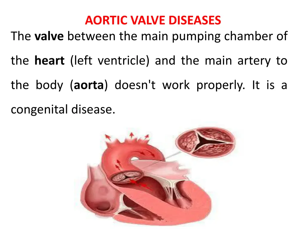 aortic valve diseases