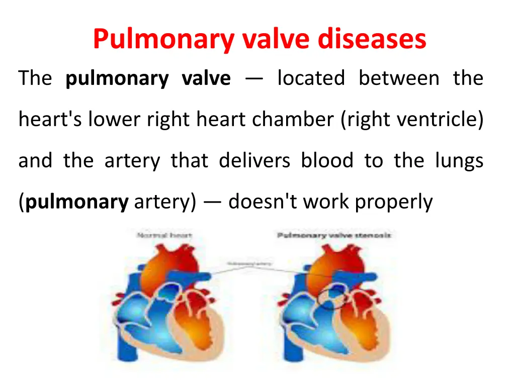 pulmonary valve diseases