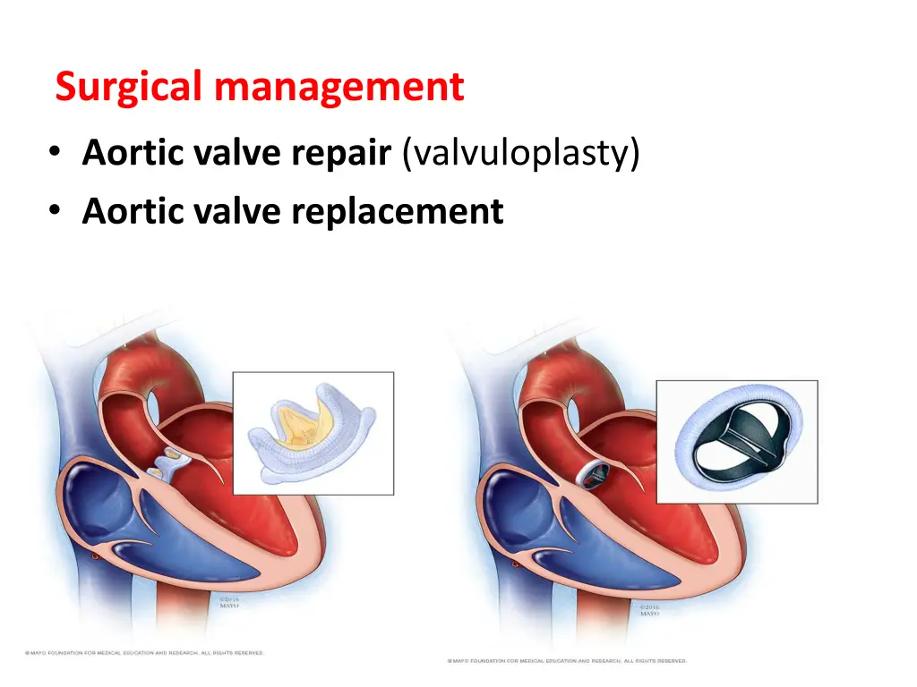 surgical management aortic valve repair