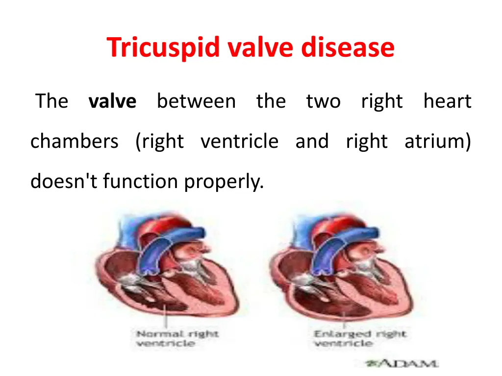 tricuspid valve disease