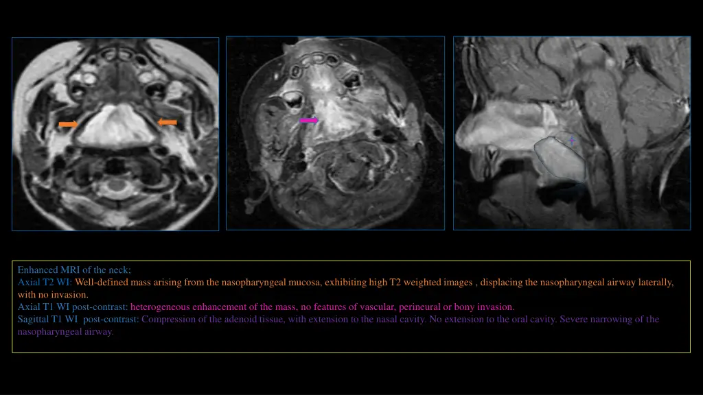 enhanced mri of the neck axial t2 wi well defined