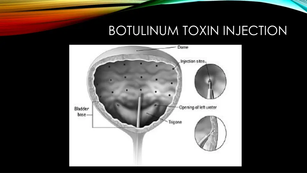 botulinum toxin injection