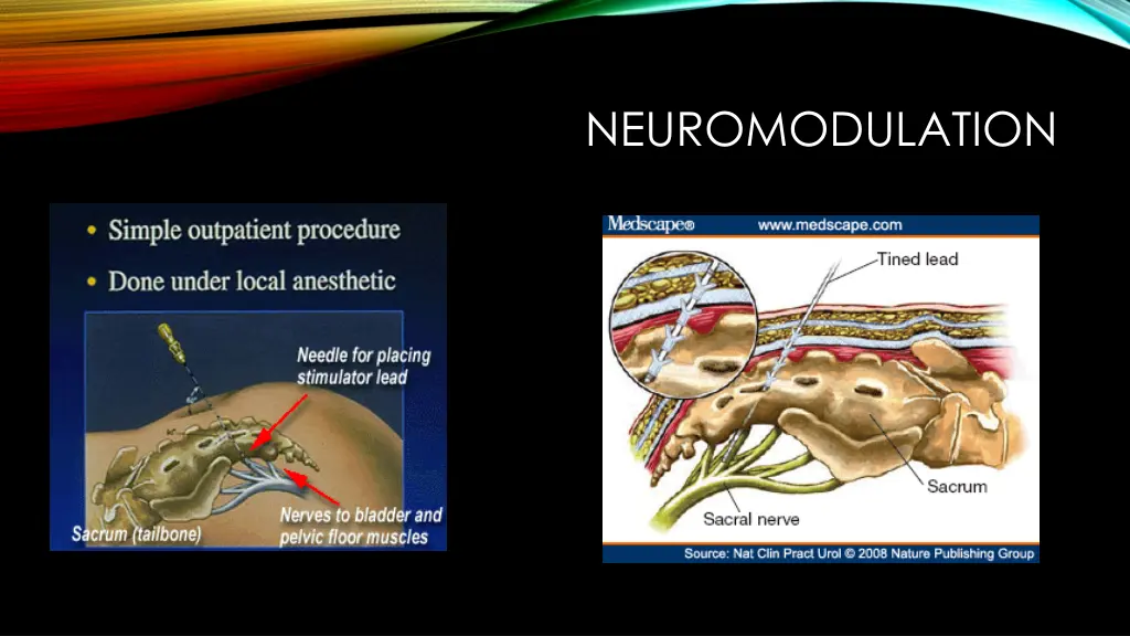 neuromodulation