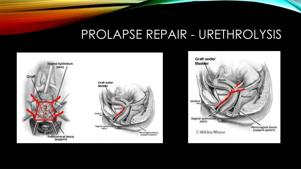 prolapse repair urethrolysis