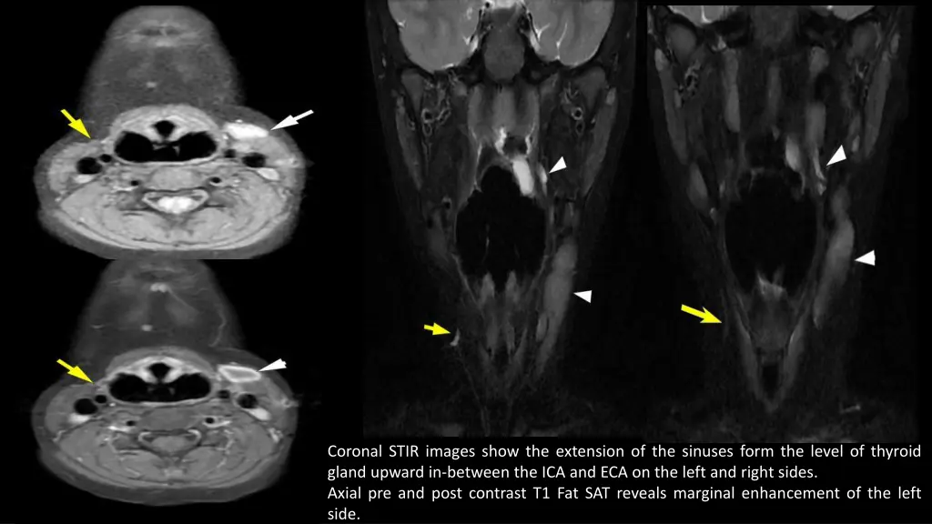 coronal stir images show the extension