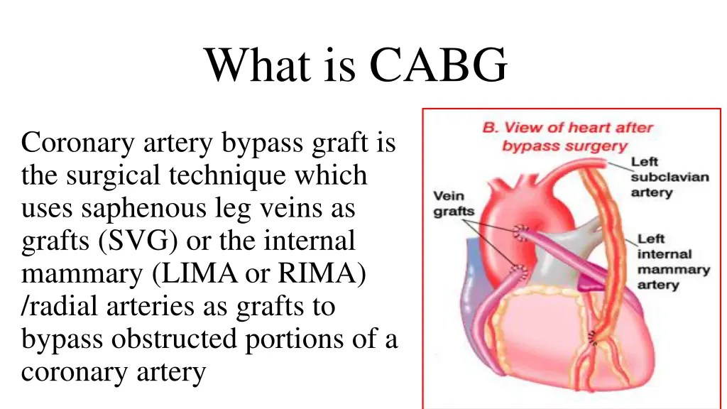 what is cabg
