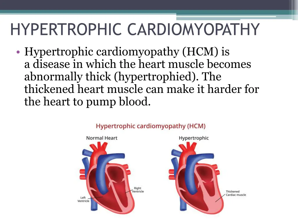 hypertrophic cardiomyopathy