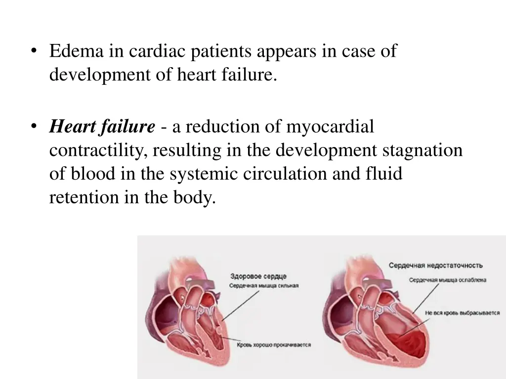 edema in cardiac patients appears in case