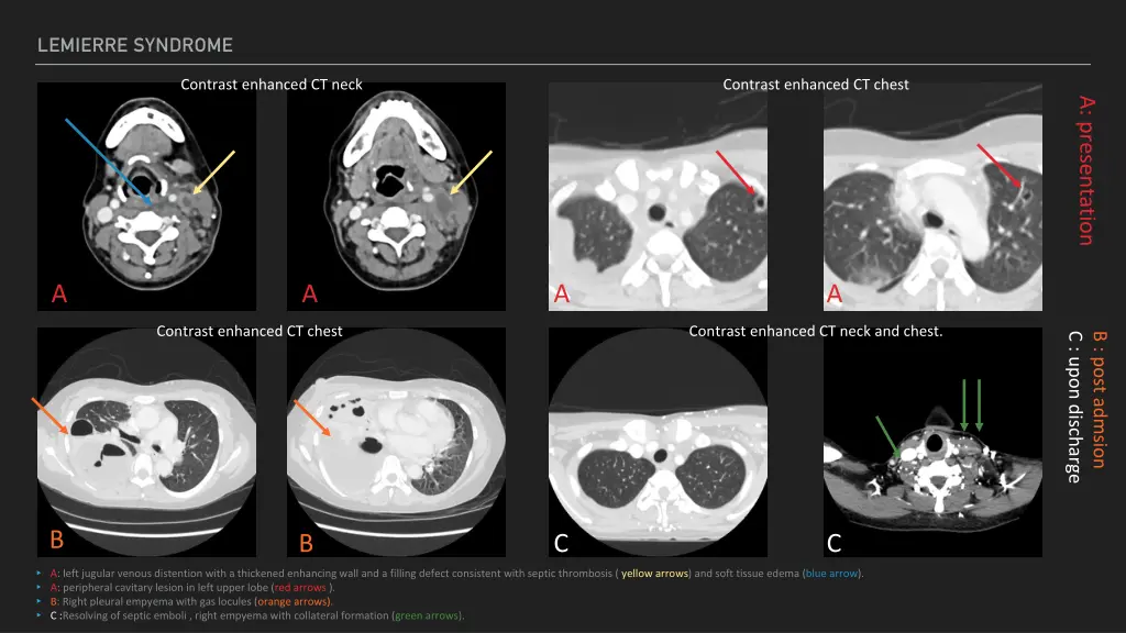 lemierre syndrome 1