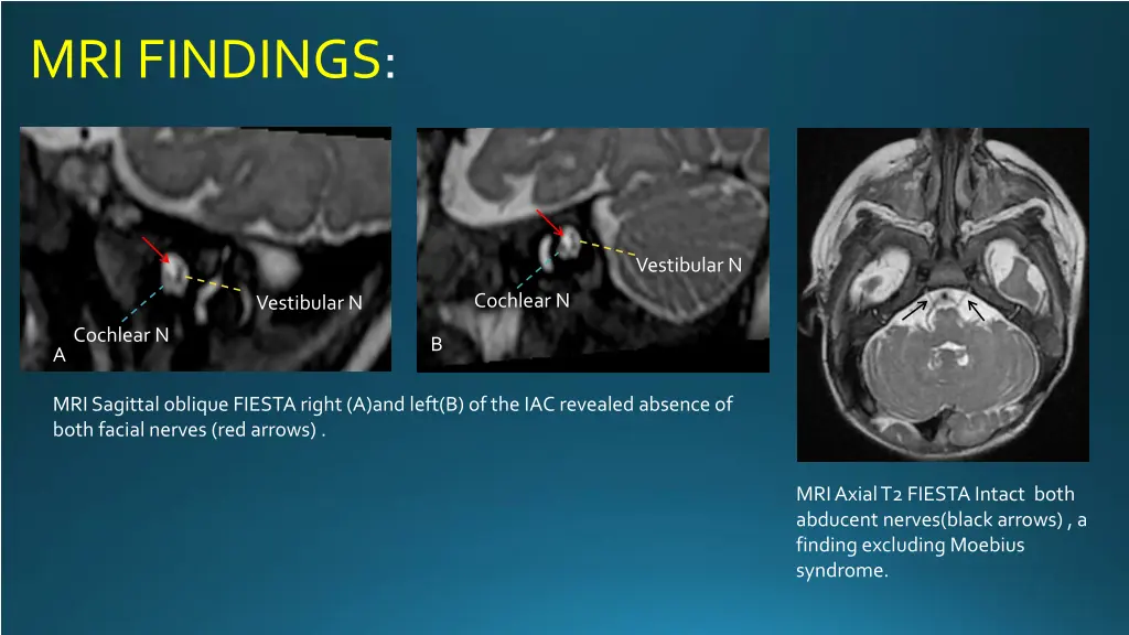 mri findings