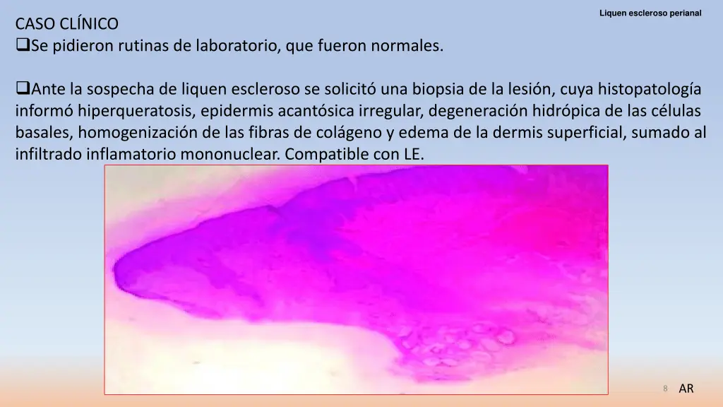 liquen escleroso perianal 5