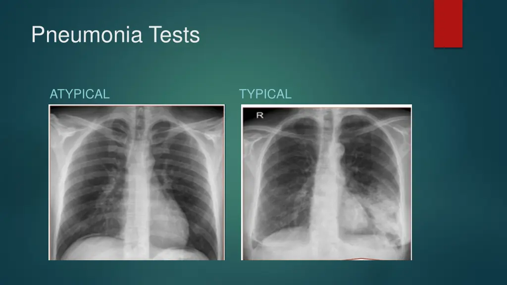 pneumonia tests