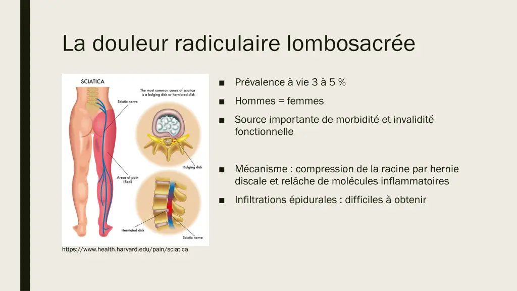 la douleur radiculaire lombosacr e
