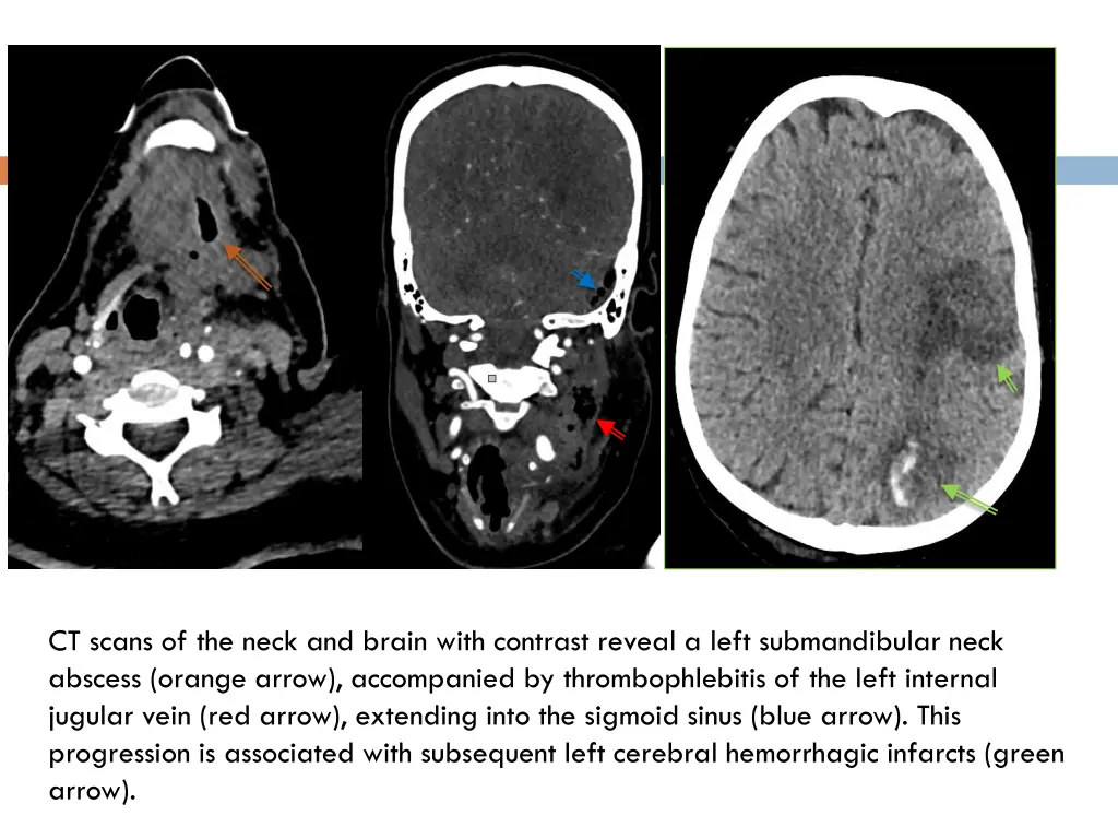 ct scans of the neck and brain with contrast