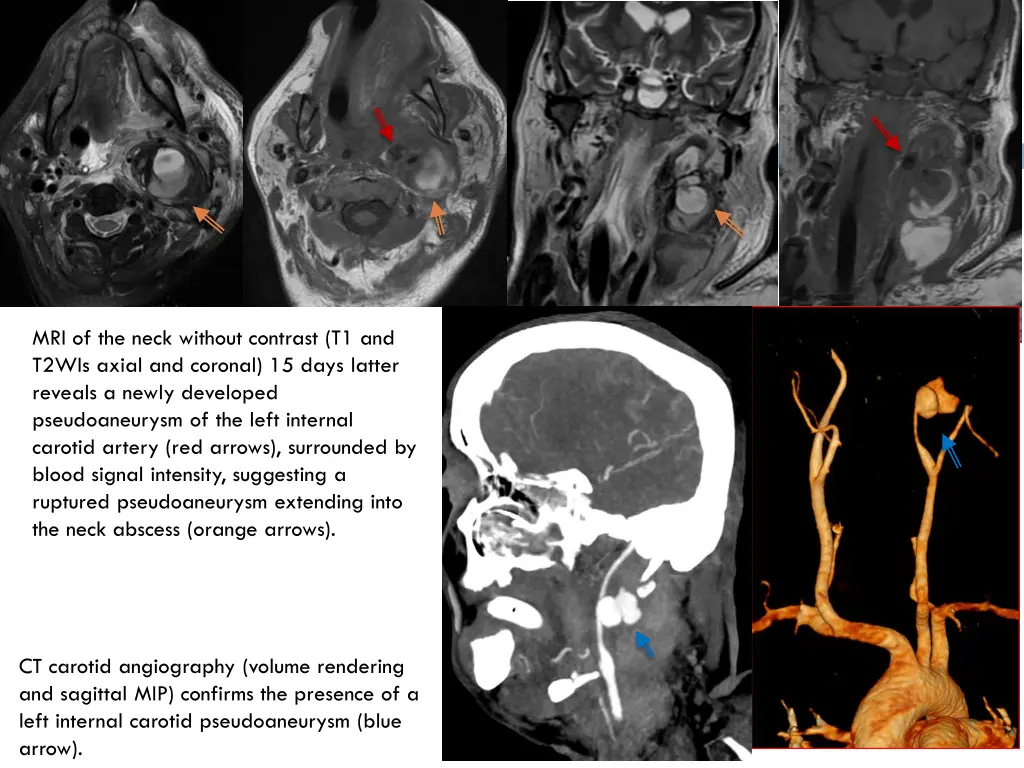 mri of the neck without contrast t1 and t2wis