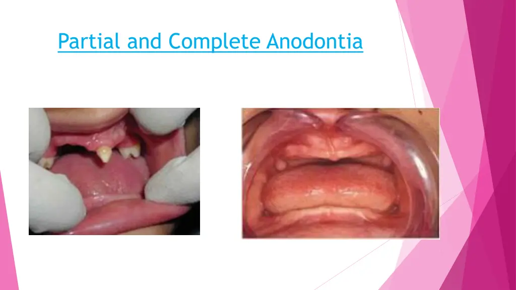 partial and complete anodontia
