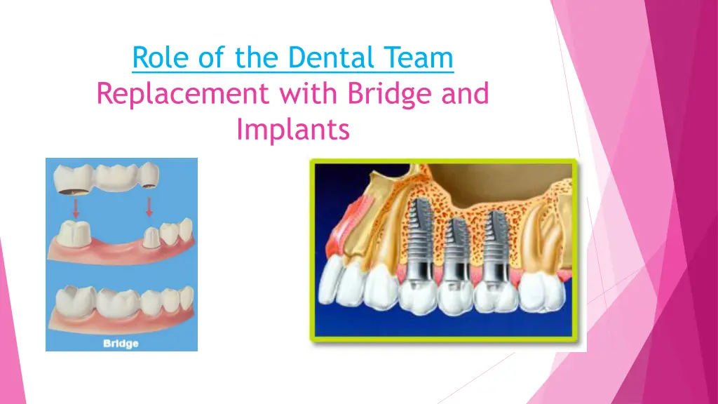 role of the dental team replacement with bridge
