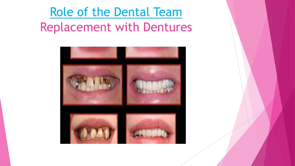 role of the dental team replacement with dentures