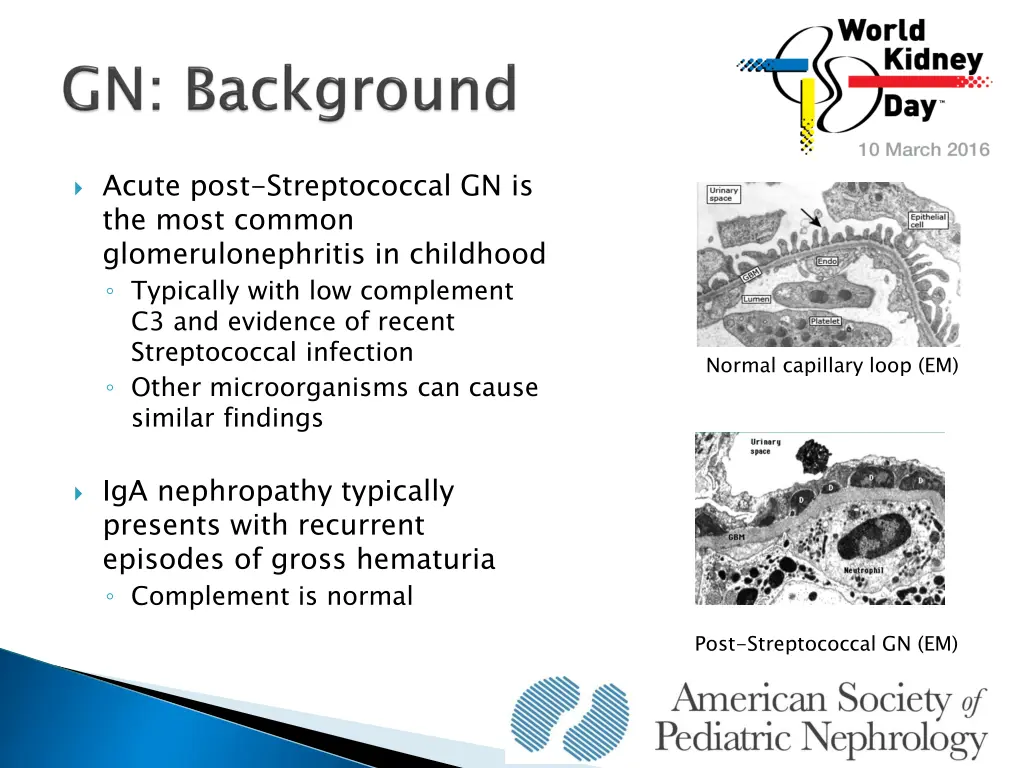 acute post streptococcal gn is the most common